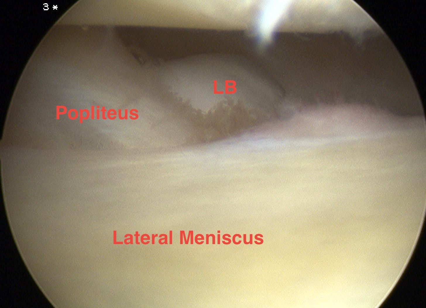 Knee Loose Body Posterolateral Corner Arthroscopy